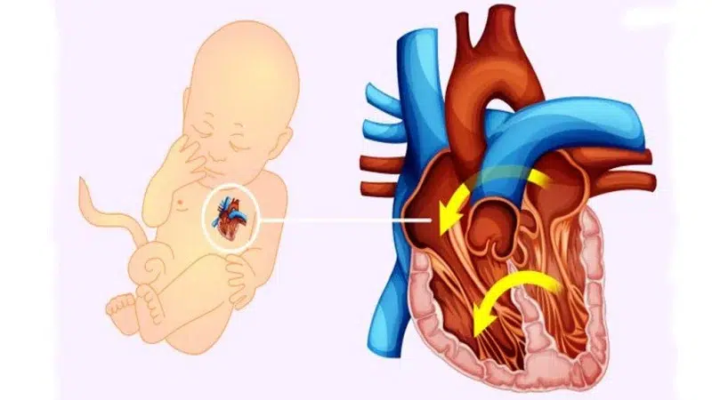 La cardiopatía congénita se diagnostica en un buen control de embarazo