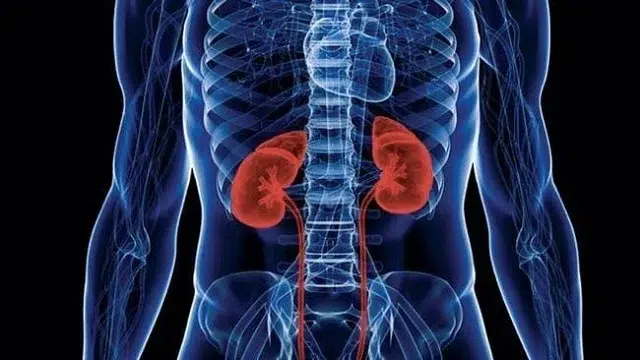 En 2023, aumentaron significativamente las muertes por insuficiencia renal crónica en Nicaragua.